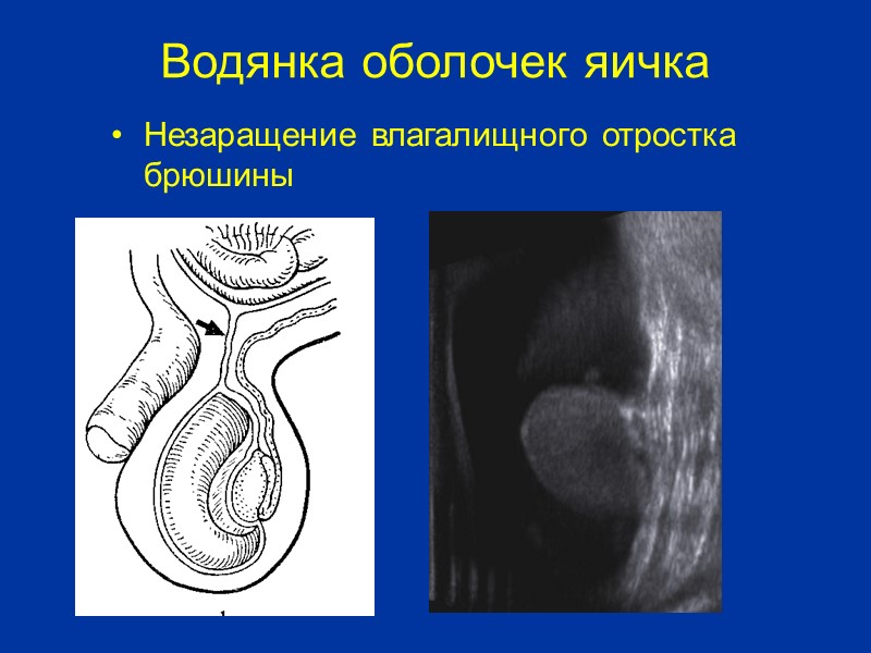 Глистная инвазия яичка (дирофиляриоз оболочек яичка) При поступлении больные предъявляли жалобы на отек и